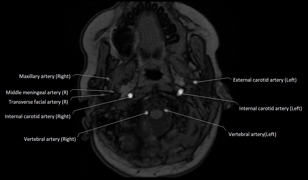 Carotid artery anatomy axial 3T image 6.jpg
